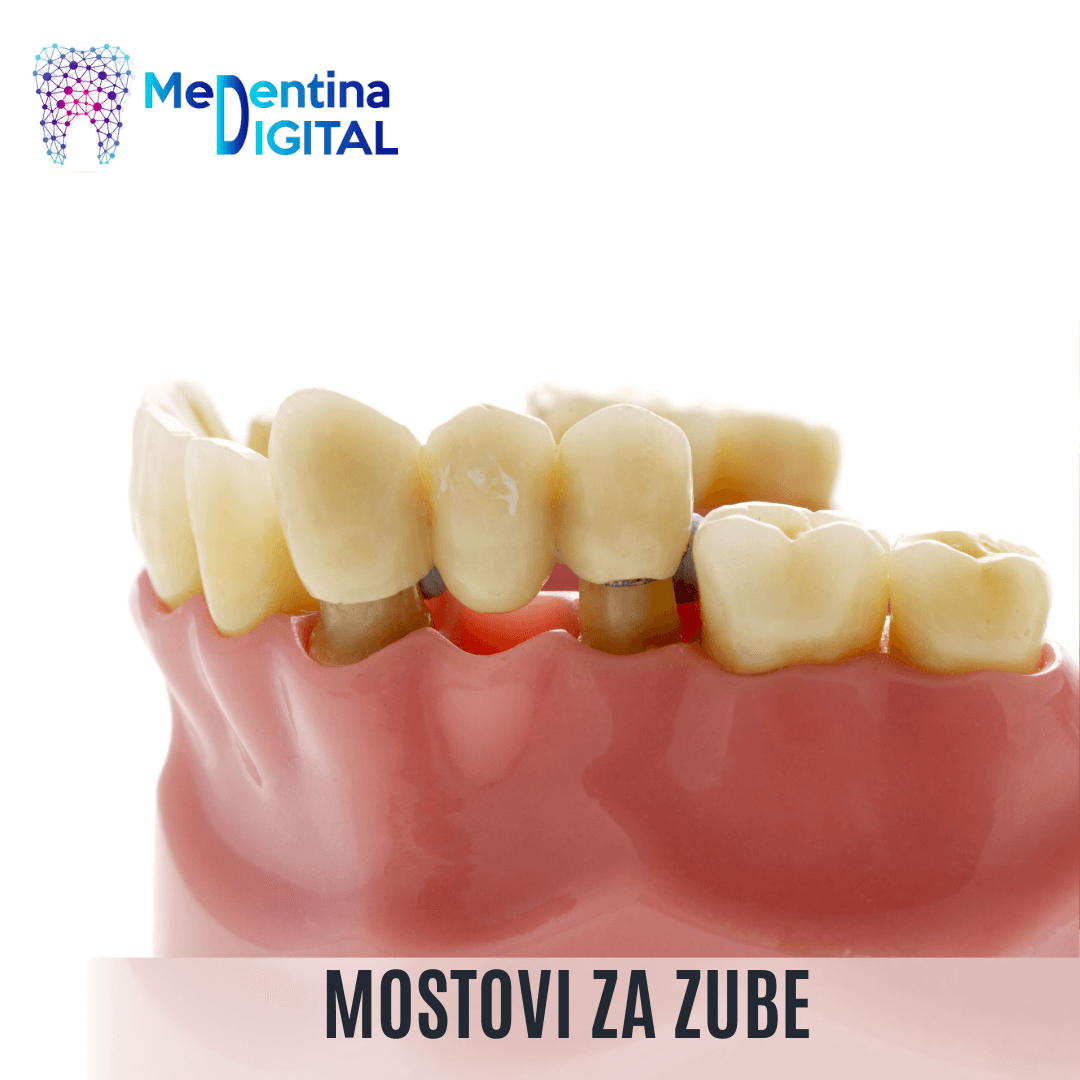 Mostovi za zube
