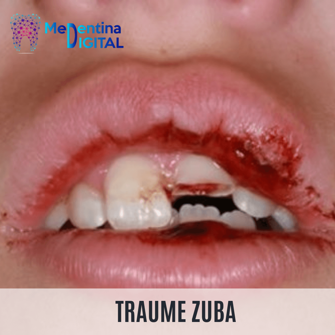 Trauma zuba