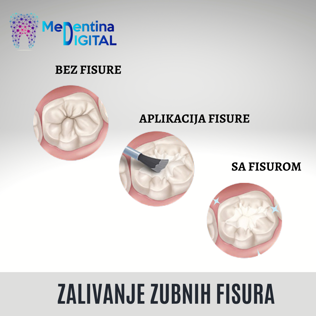 Zalivanje fisura zuba