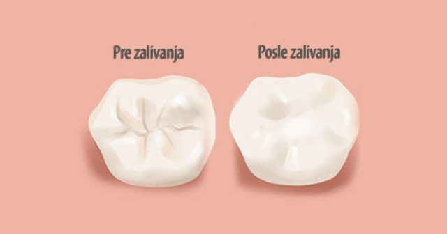 Zalivanje fisura zuba