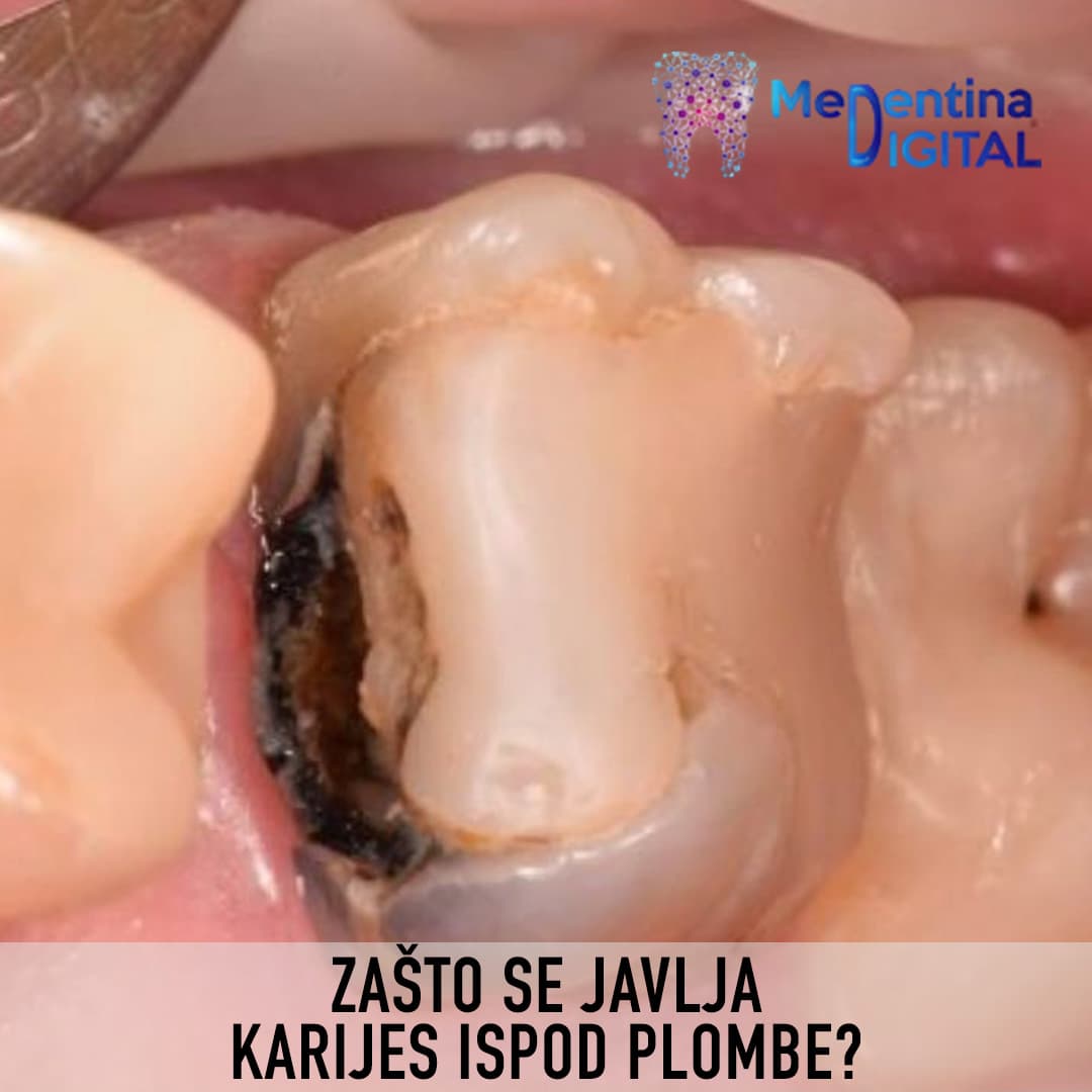 Zašto se javlja karijes ispod plombe?