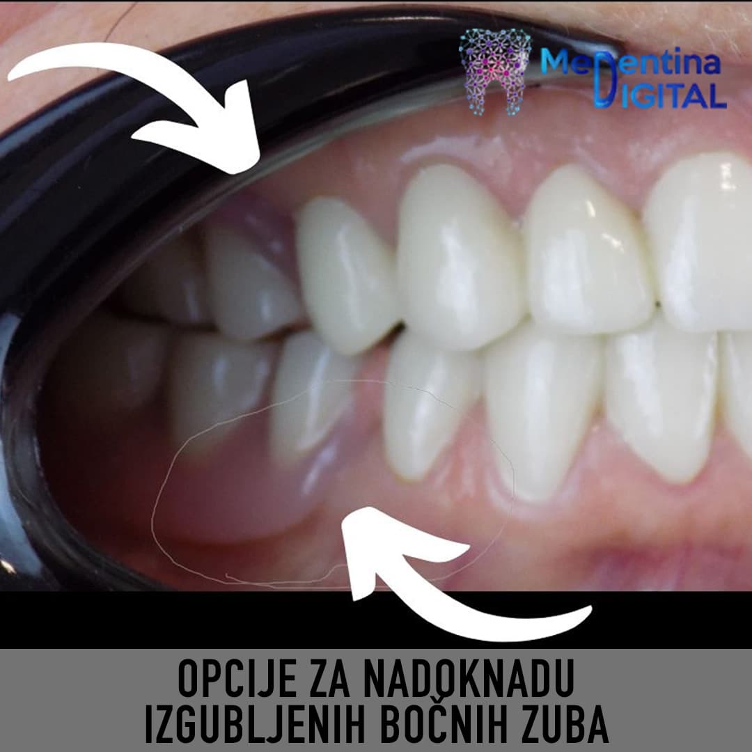 Opcije za nadoknadu izgubljenih bočnih (zadnjih) zuba