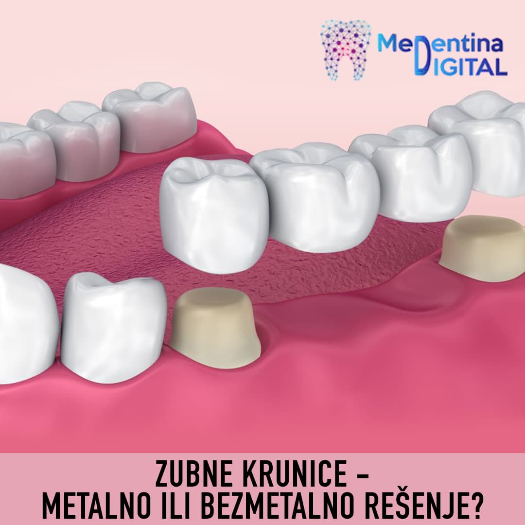 Zubne krunice – metalno ili bezmetalno rešenje?