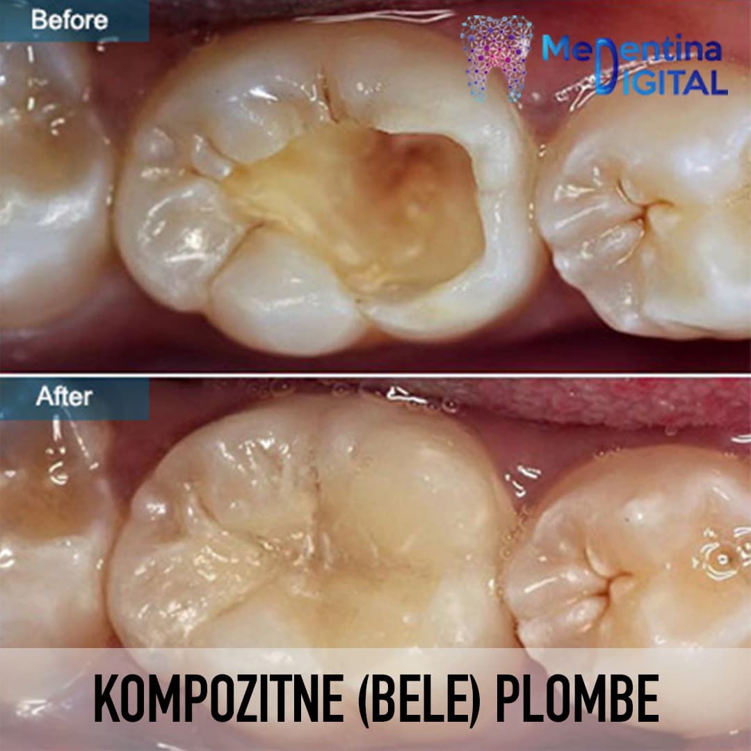 Kompozitne (bele) plombe