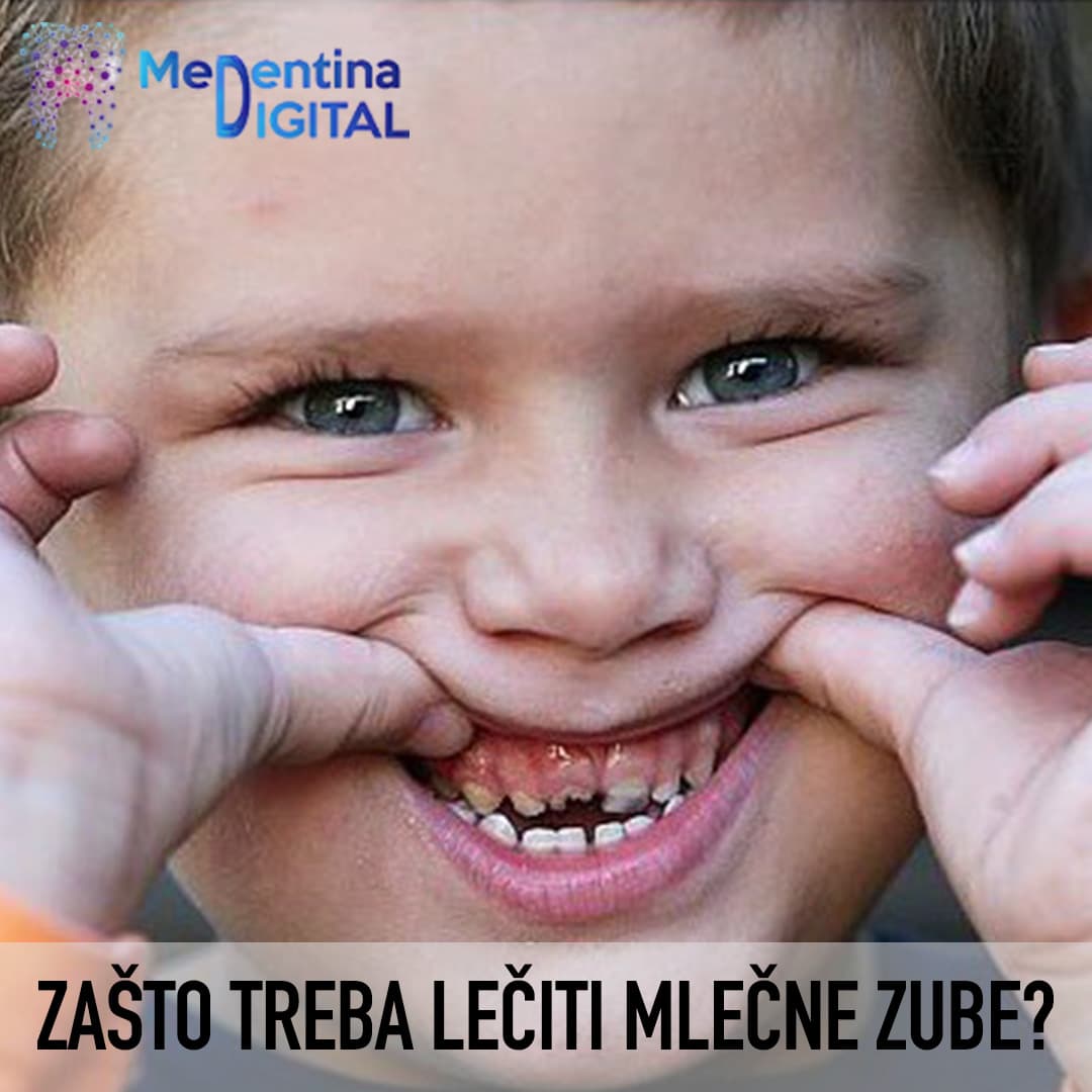 Zašto treba lečiti mlečne zube?
