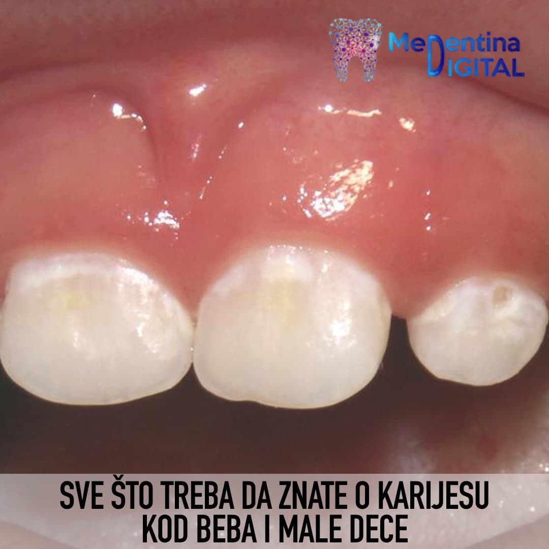 Sve što treba da znate o karijesu kod beba i male dece