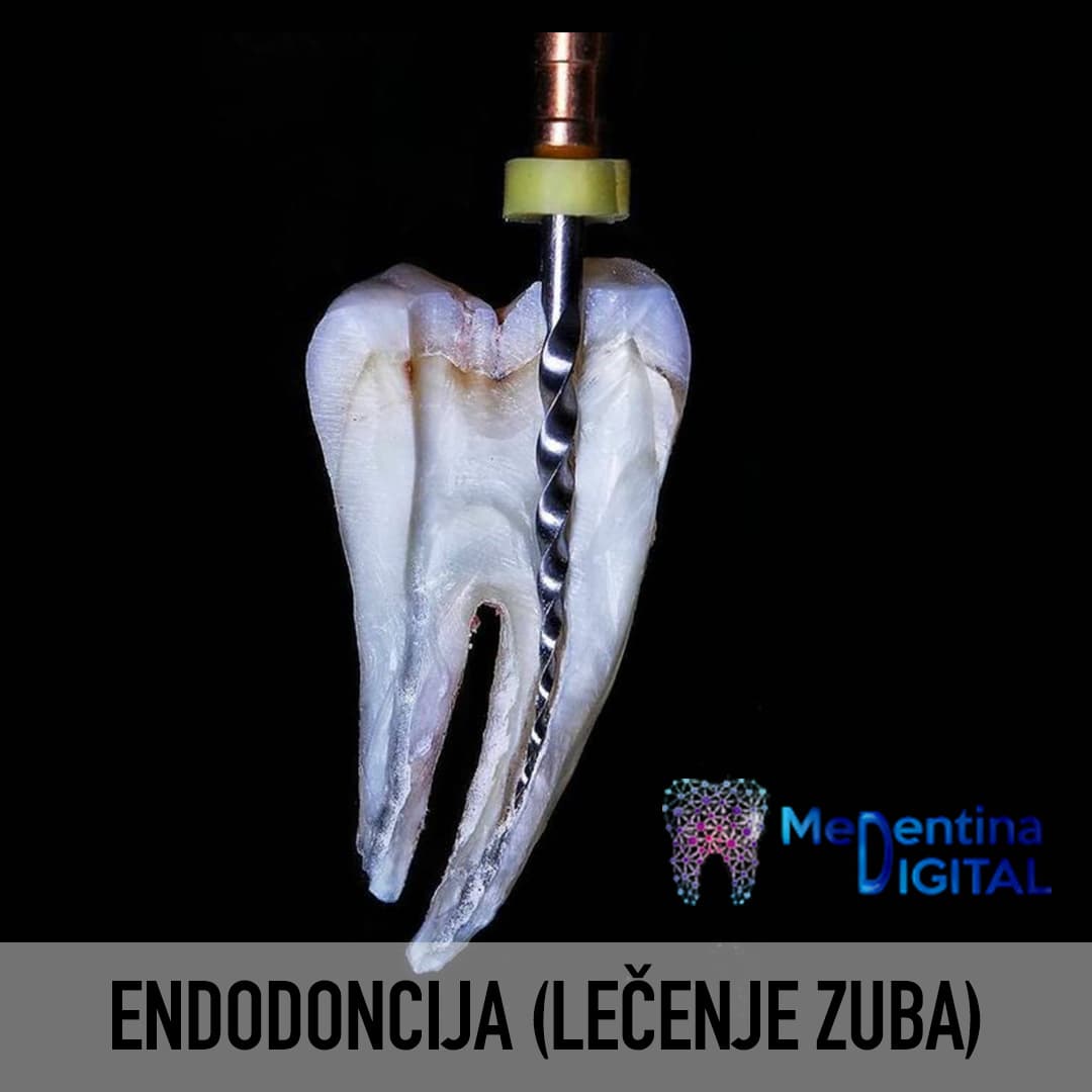 Endodoncija (lečenje zuba)