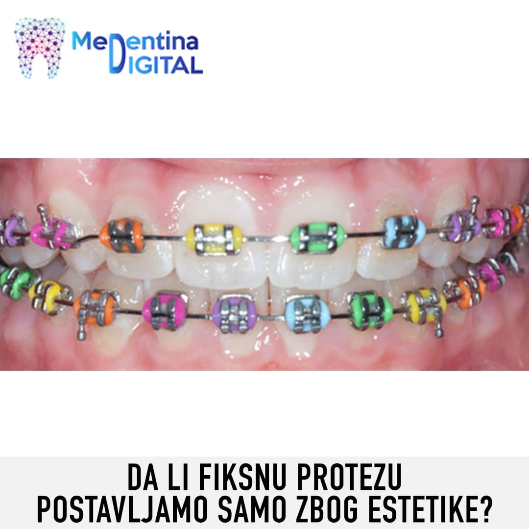 Da li fiksnu protezu postavljamo samo zbog estetike?